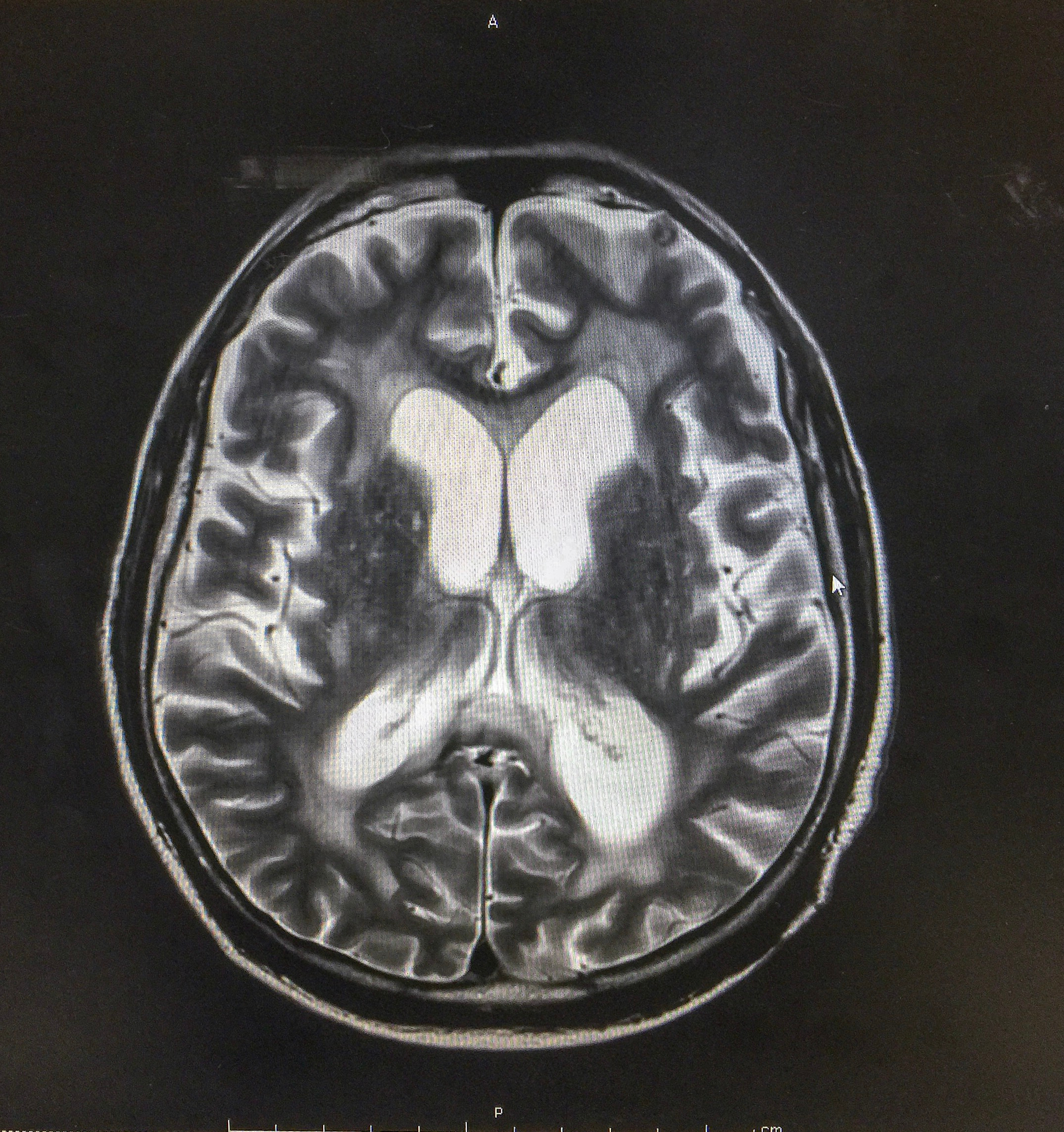 Implante no cérebro? Entenda como é a cirurgia de Chico Buarque