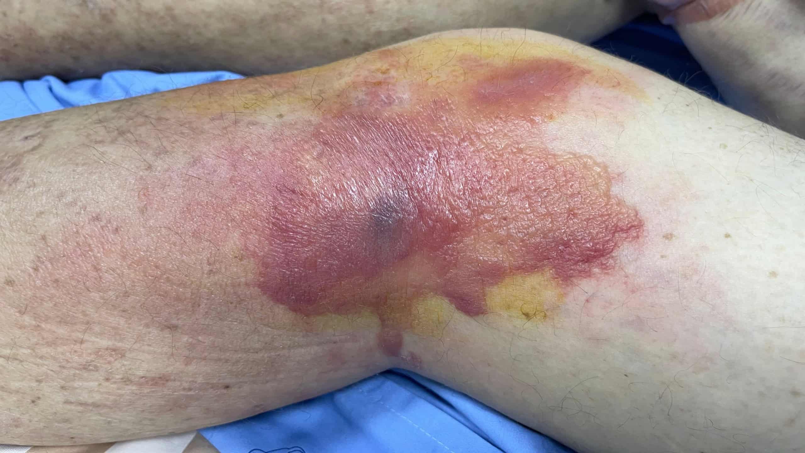 O que é celulite infecciosa? Conheça sintomas e formas de tratamento